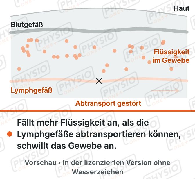 Vorschau: Wie ein Lymphödem entsteht