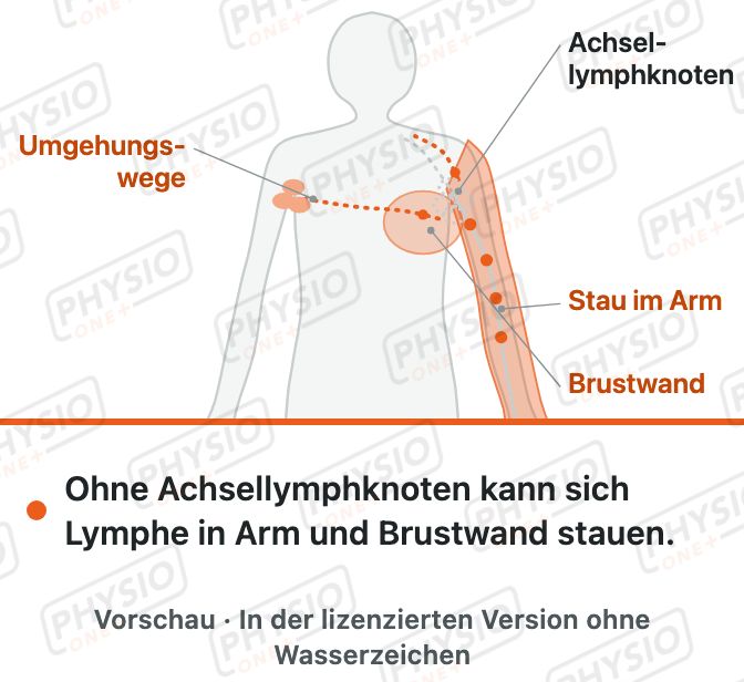 Vorschau: Lymphödem nach Brustkrebs-OP