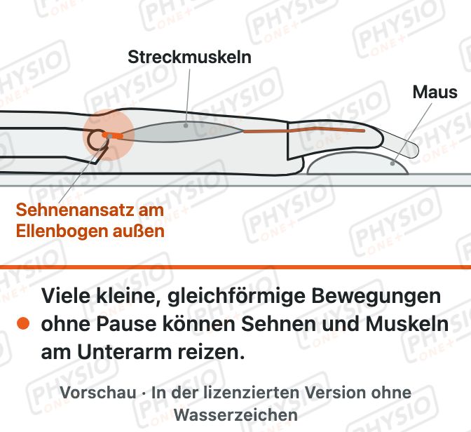 Vorschau: Mausarm: Überlastung durch Bildschirmarbeit