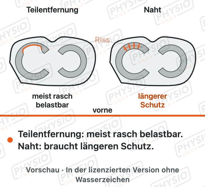 Vorschau: Meniskus-OP: Teilentfernung oder Naht