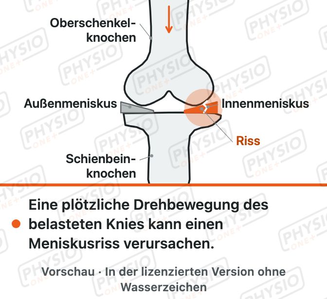Vorschau: Meniskus