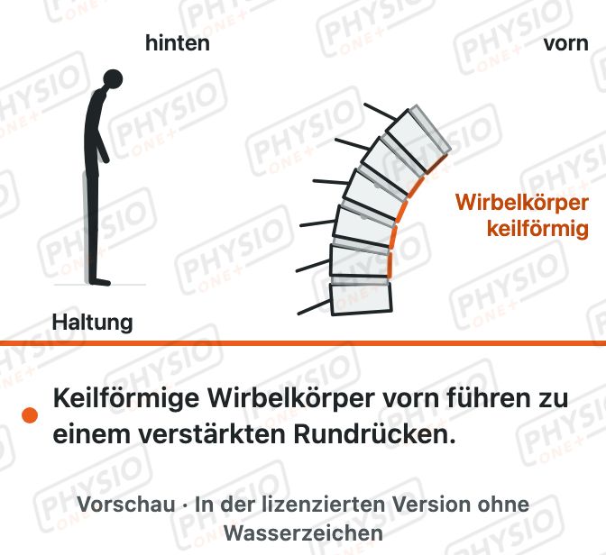 Vorschau: Morbus Scheuermann