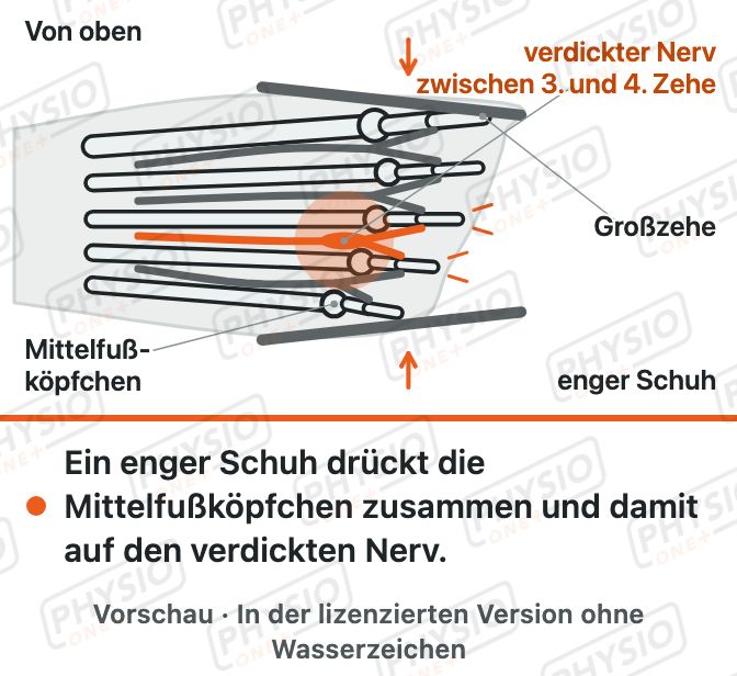 Vorschau: Nervenschmerz im Vorfuß