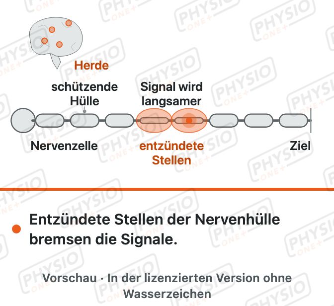 Vorschau: Multiple Sklerose