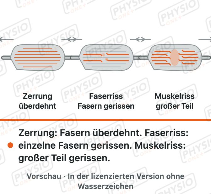 Vorschau: Muskelzerrung und Muskelfaserriss