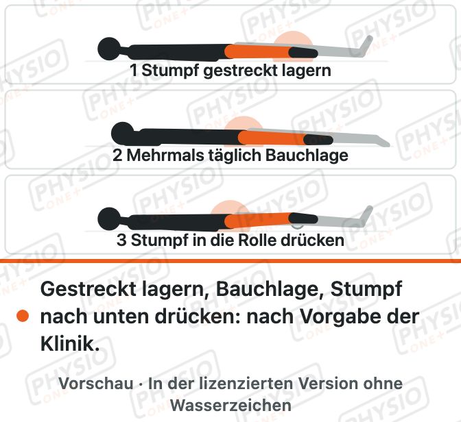 Vorschau: Nach einer Beinamputation: Lagerung und erste Übungen