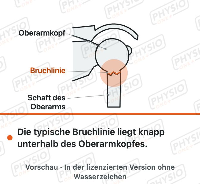Vorschau: Bruch des Oberarmkopfes