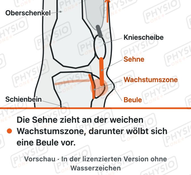 Vorschau: Wachstumsschmerz unter der Kniescheibe