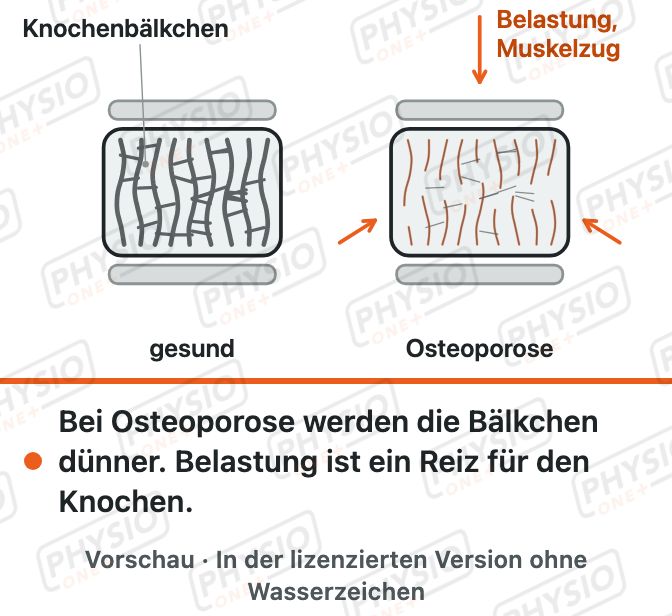 Vorschau: Osteoporose und Wirbelkörper