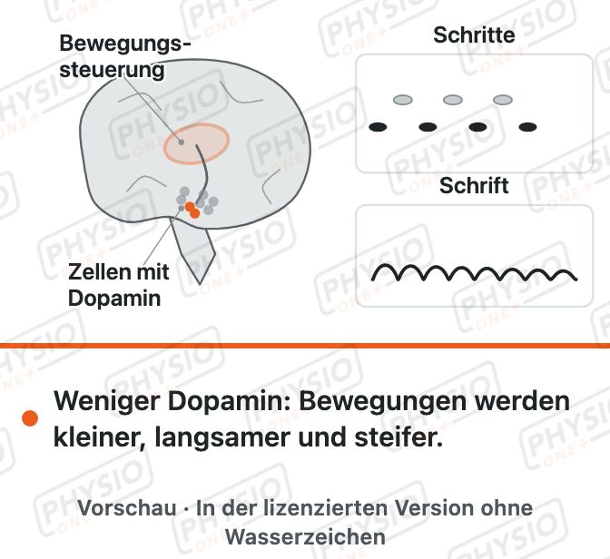 Vorschau: Parkinson: was im Gehirn passiert