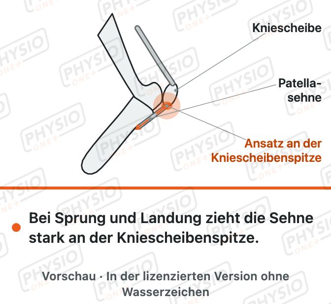 Vorschau: Schmerz unterhalb der Kniescheibe (Patellaspitzensyndrom)
