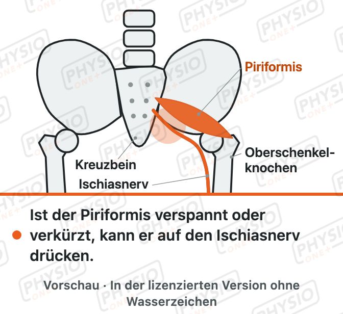 Vorschau: Piriformis und Ischiasnerv