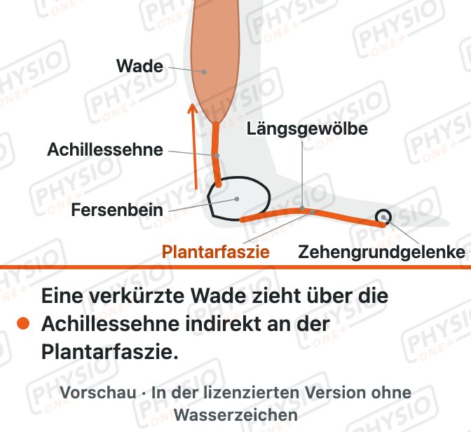 Vorschau: Fersenschmerz an der Fußsohle (Plantarfasziitis)