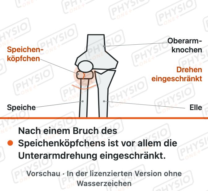 Vorschau: Bruch des Speichenköpfchens (Radiusköpfchen)