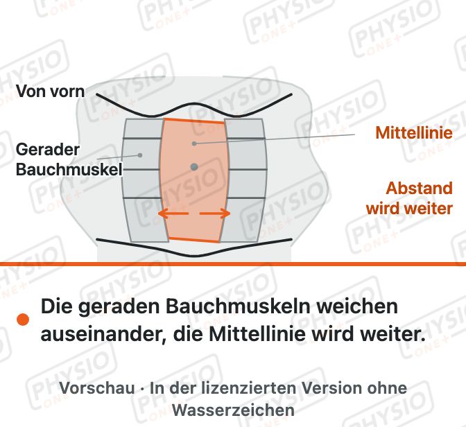 Vorschau: Spalt zwischen den geraden Bauchmuskeln (Rektusdiastase)