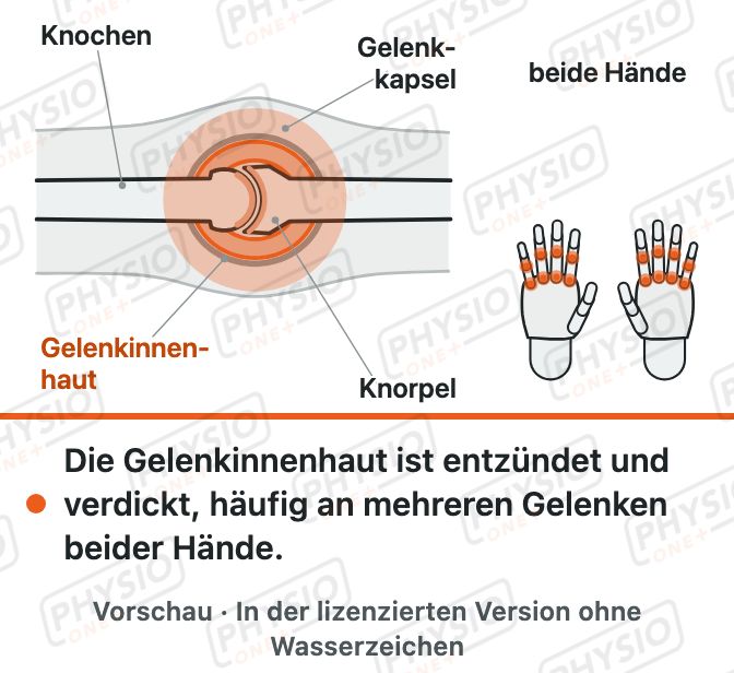 Vorschau: Rheumatoide Arthritis