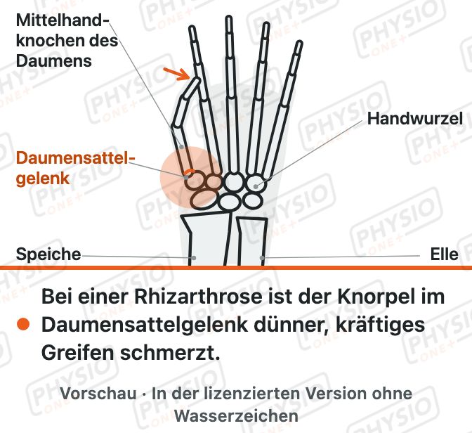 Vorschau: Arthrose am Daumensattelgelenk (Rhizarthrose)