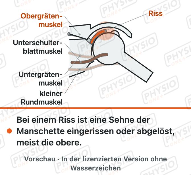 Vorschau: Rotatorenmanschette