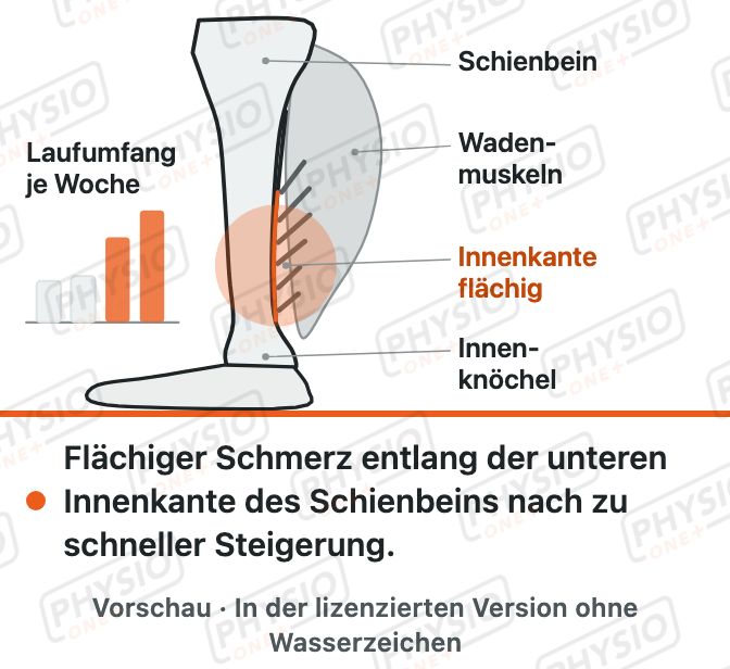 Vorschau: Schienbeinkantensyndrom