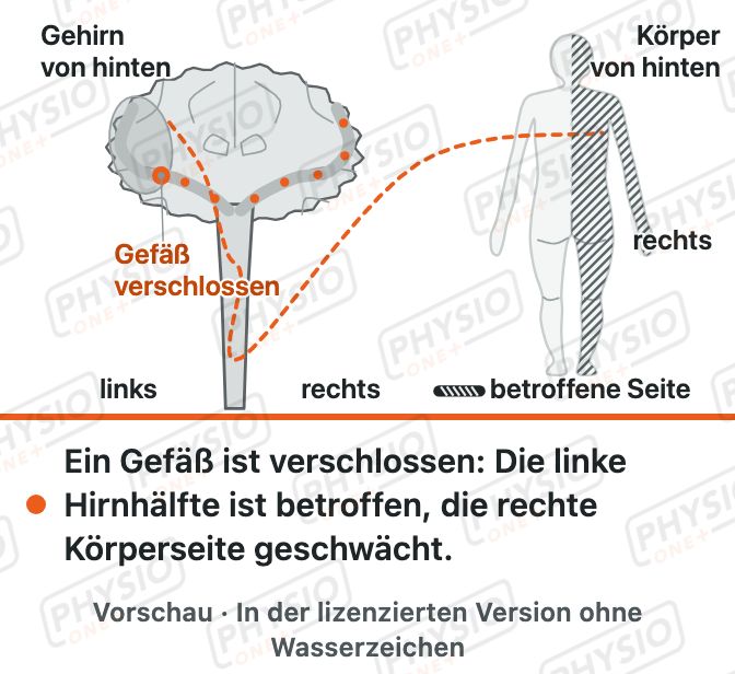 Vorschau: Schlaganfall: was im Gehirn passiert