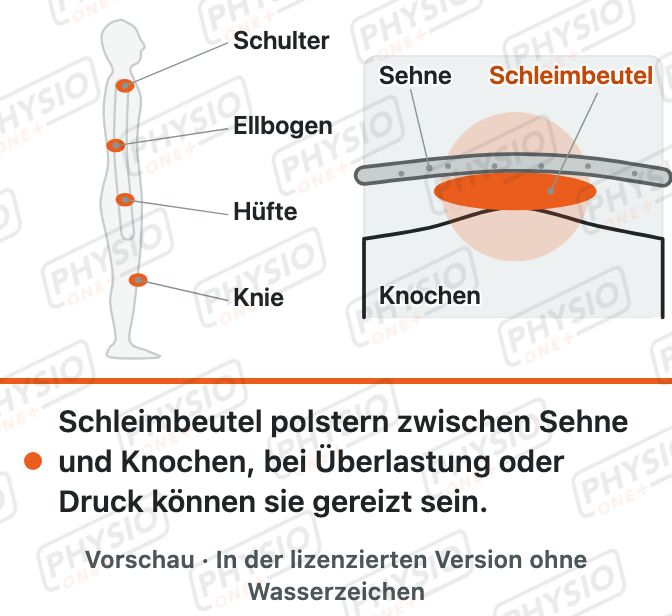 Vorschau: Schleimbeutel: Polster zwischen Sehne und Knochen