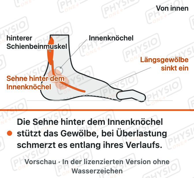 Vorschau: Schmerz an der Fußinnenseite