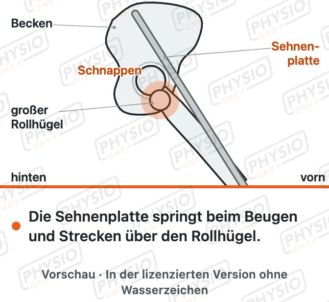 Vorschau: Schnappende Hüfte