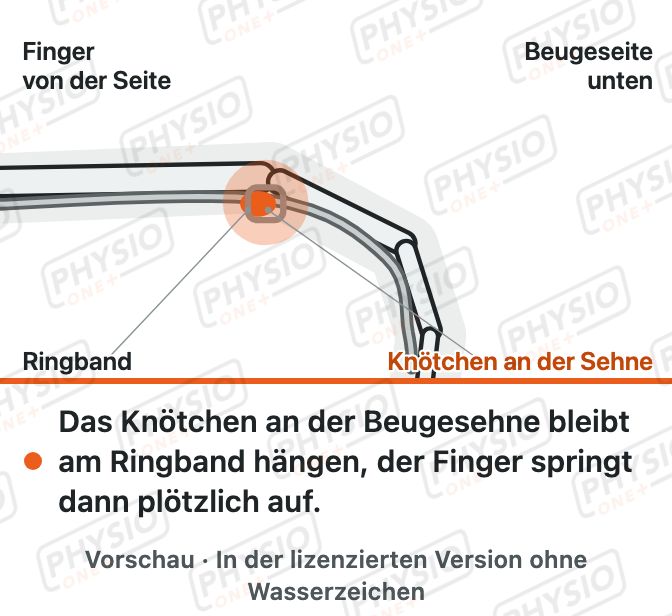 Vorschau: Schnellender Finger