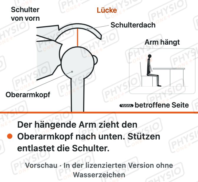 Vorschau: Schulter nach Schlaganfall schützen