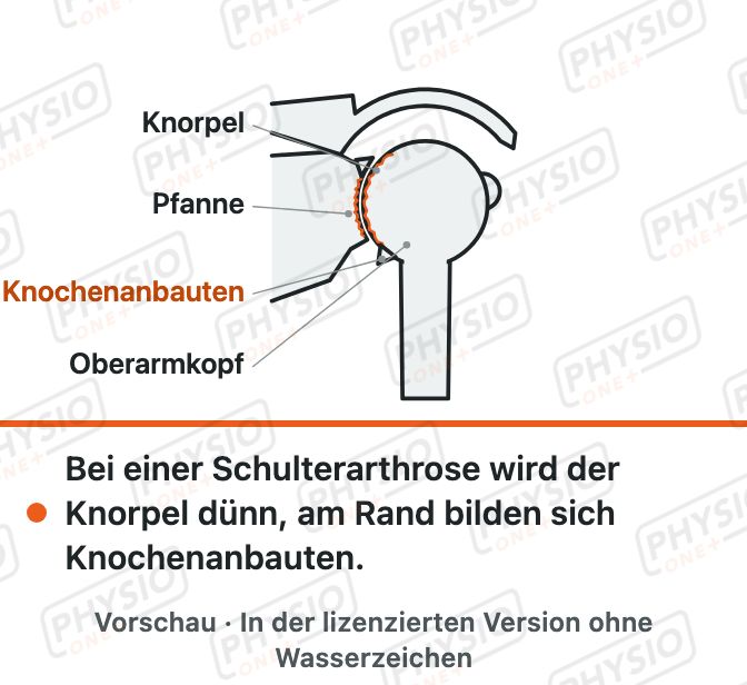 Vorschau: Schulterarthrose