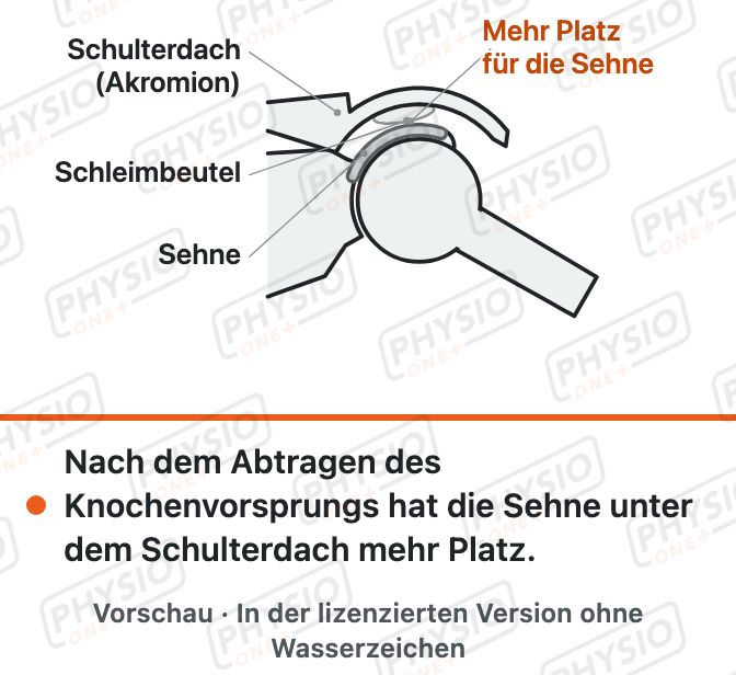 Vorschau: Erweiterung unter dem Schulterdach