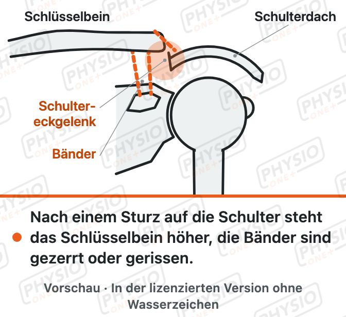 Vorschau: Das Schultereckgelenk
