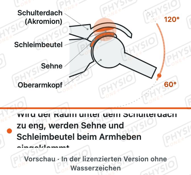 Vorschau: Enge unter dem Schulterdach (Schulterimpingement)