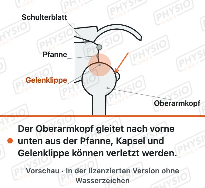 Vorschau: Schulterluxation und Instabilität