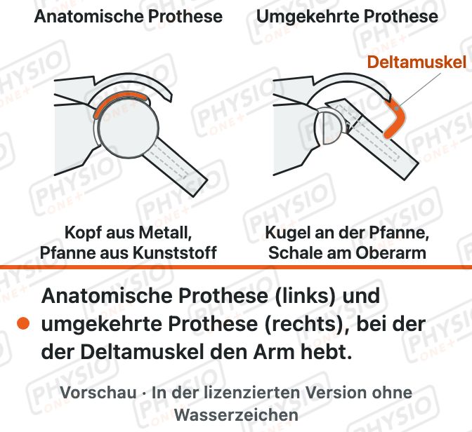 Vorschau: Die Schulterprothese