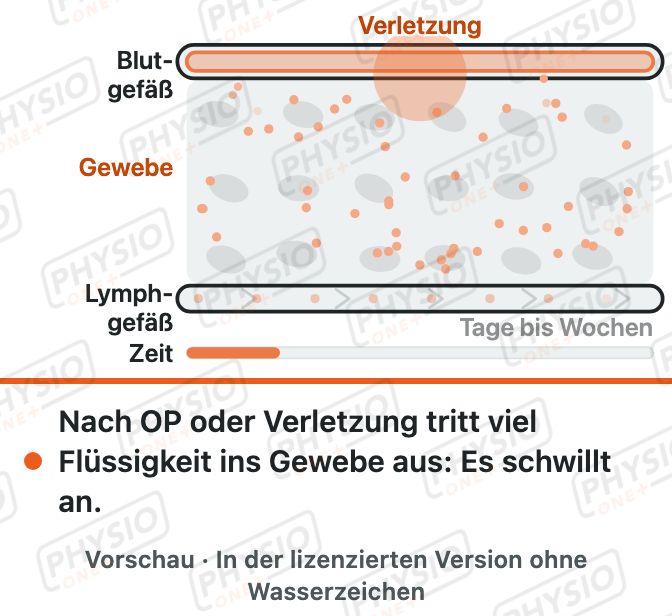 Vorschau: Schwellung nach OP oder Verletzung