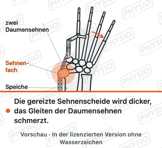 Vorschau: Sehnenscheidenentzündung am Daumen