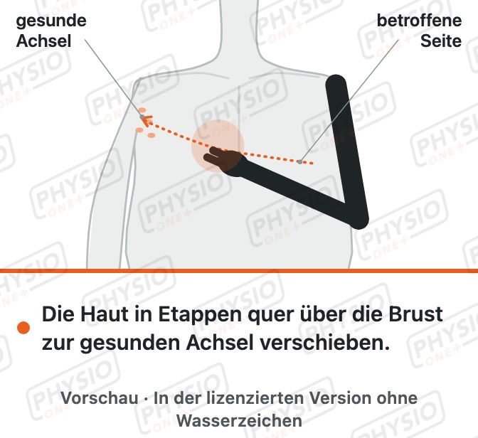 Vorschau: Haut über die Brust zur gesunden Achsel verschieben