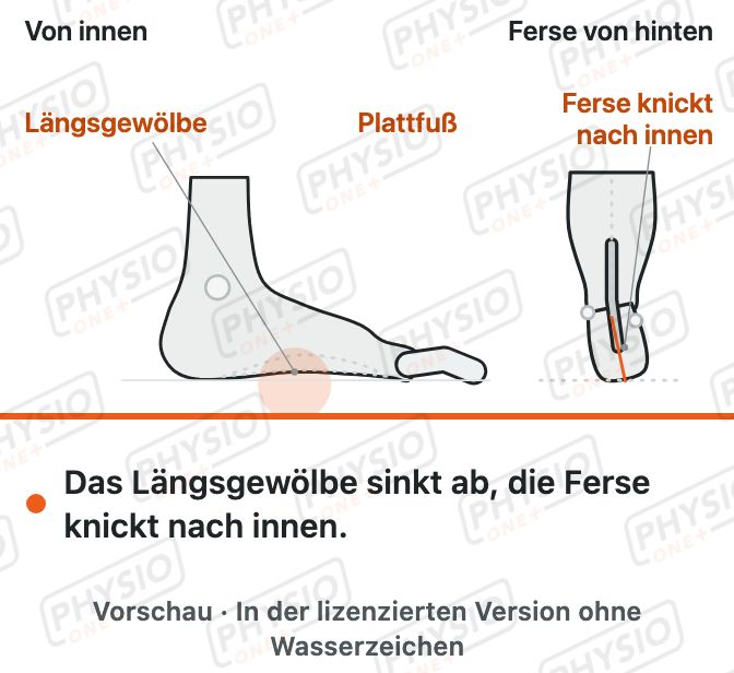 Vorschau: Senkfuß und Plattfuß