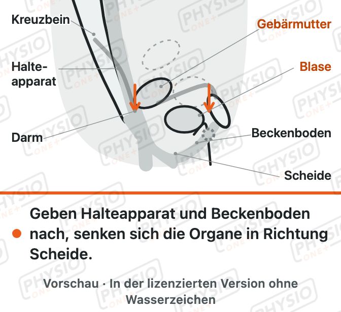 Vorschau: Senkung von Blase und Gebärmutter