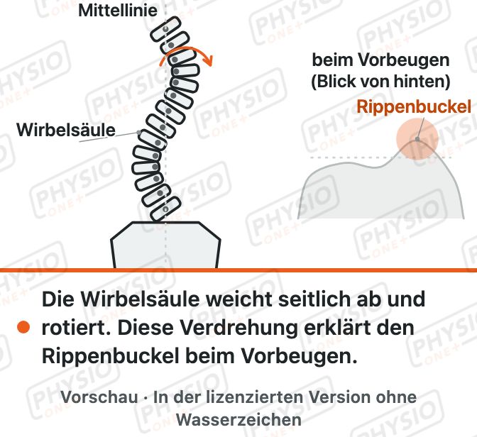 Vorschau: Skoliose