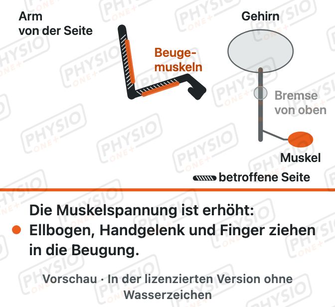 Vorschau: Spastik: erhöhte Muskelspannung