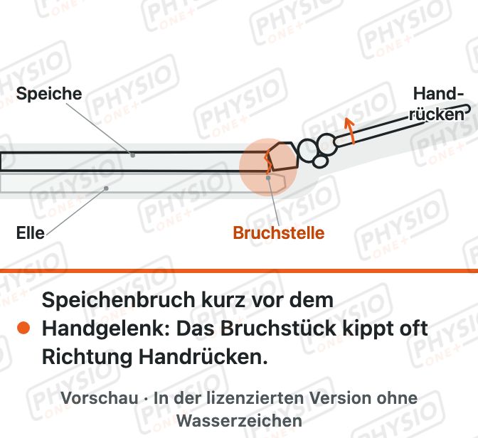 Vorschau: Speichenbruch am Handgelenk