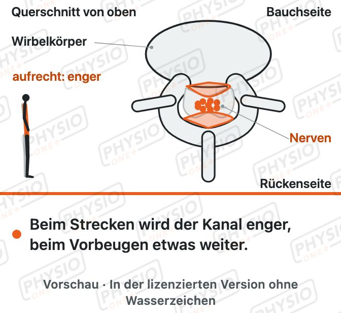 Vorschau: Enger Wirbelkanal (Spinalkanalstenose)