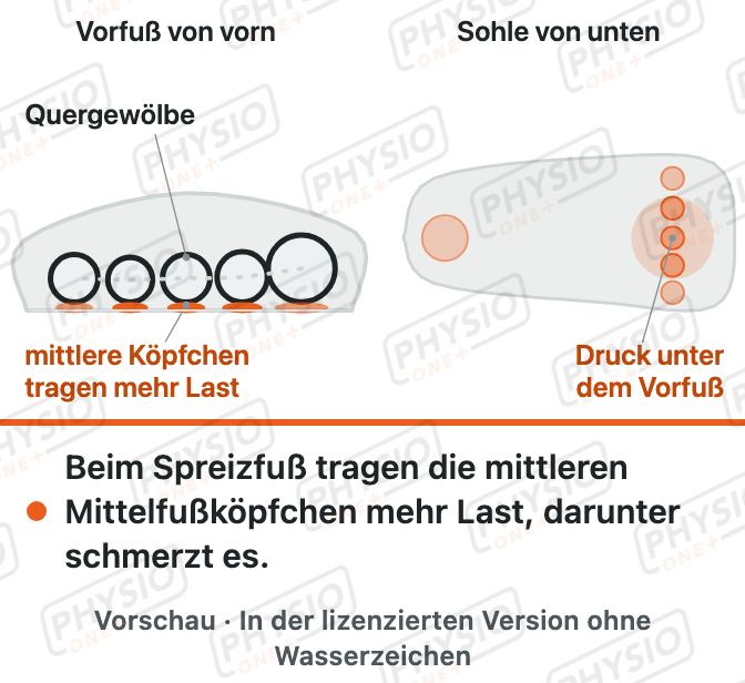 Vorschau: Spreizfuß und Schmerz unter dem Vorfuß