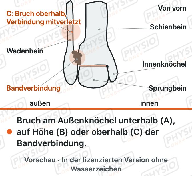 Vorschau: Bruch am Sprunggelenk