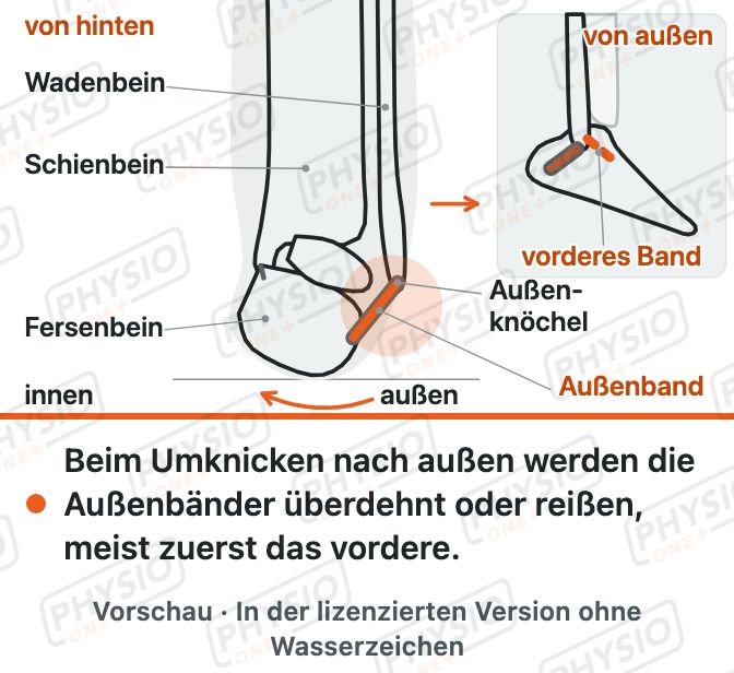 Vorschau: Umknicken des Sprunggelenks