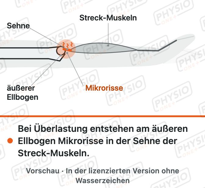 Vorschau: Tennisarm