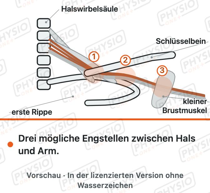 Vorschau: Engpass zwischen Hals und Arm