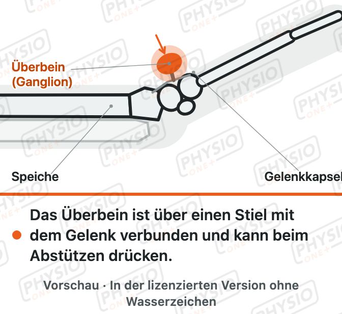 Vorschau: Überbein am Handgelenk